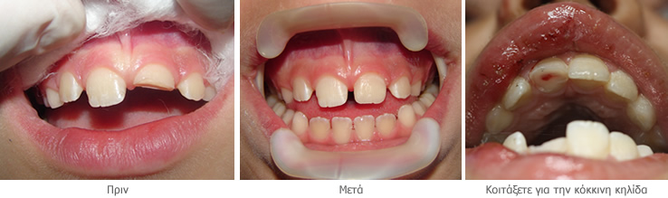 dentaltrauma2