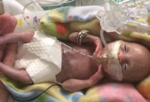 Αυτό είναι το πιο πρόωρο βρέφος που επέζησε ποτέ -δείτε την ιστορία του!
