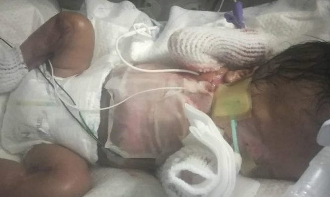 Μωρό γεννήθηκε χωρίς δέρμα – Οι ανατριχιαστικές εικόνες και η προσπάθεια των γιατρών για να το σώσουν