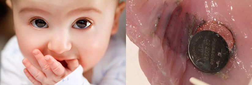 Δύο ανατριχιαστικές φωτογραφίες δείχνουν τι θα συμβεί στο παιδί αν καταπιεί μπαταρία