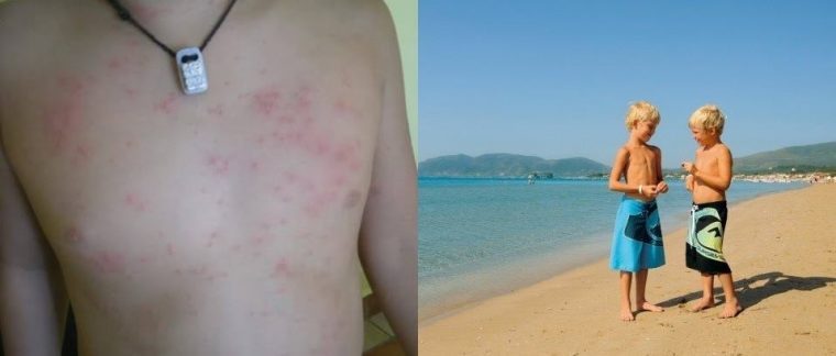 Πόσο επικίνδυνες είναι οι ψείρες της θάλασσας; Όλα όσα πρέπει να ξέρετε