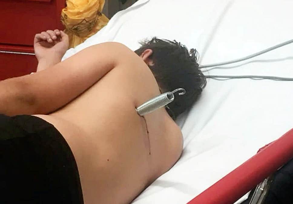 Καρφώθηκε ελατήριο από τραμπολίνο στην πλάτη 12χρονου! (εικόνες-σοκ)