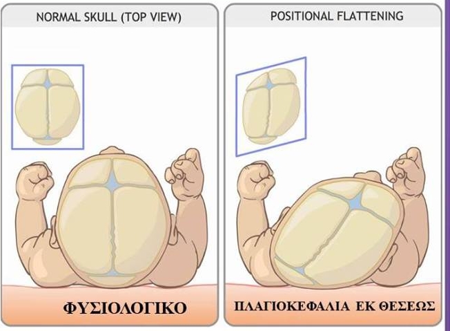 Τι είναι η πλαγιοκεφαλία, πότε εμφανίζεται και πώς μπορούμε να την αντιμετωπίσουμε;