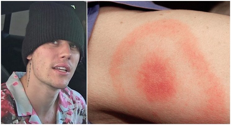 Τι είναι η νόσος του Lyme από την οποία πάσχουν Justin Bieber και Avril Lavigne;