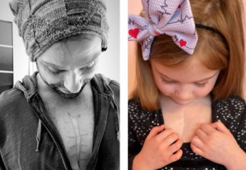 Φοβερός μπαμπάς έκανε τατουάζ την ουλή της κόρης του μετά από εγχείριση ανοιχτής καρδιάς