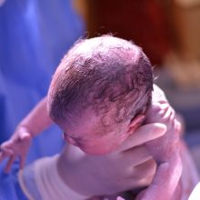 Τι είναι το Σύνδρομο CHAOS; Η σπάνια περίπτωση ενός μωρού που σώθηκε με τη διαδικασία EXIT