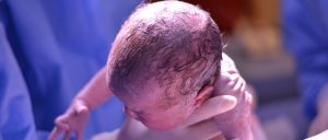 Τι είναι το Σύνδρομο CHAOS; Η σπάνια περίπτωση ενός μωρού που σώθηκε με τη διαδικασία EXIT