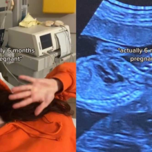 Βρέθηκε στα Επείγοντα με “πρήξιμο” και ανακάλυψε ότι είναι 6 μηνών έγκυος!