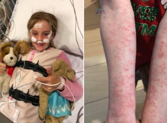 Ακτινική Κνήφη: Μία σπάνια περίπτωση αλλεργίας στο φως του ήλιου - Η περίπτωση μίας 11χρονης