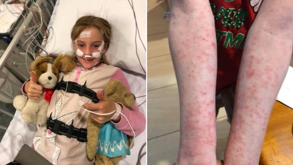 Ακτινική Κνήφη: Μία σπάνια περίπτωση αλλεργίας στο φως του ήλιου - Η περίπτωση μίας 11χρονης