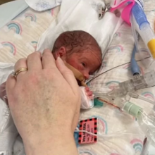 Μωρό - θαύμα γεννήθηκε πρόωρα με όγκο διπλάσιο από το μέγεθός του - Πώς τα κατάφερε
