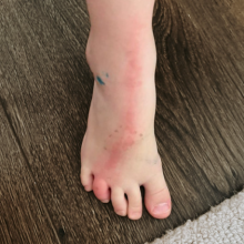 Τι σημαίνει, αν δείτε αυτήν την κόκκινη γραμμή στο πόδι του παιδιού σας;